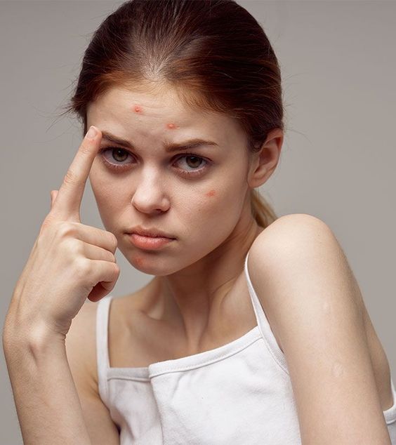 Acne Clearance Treatment Gorakhpur