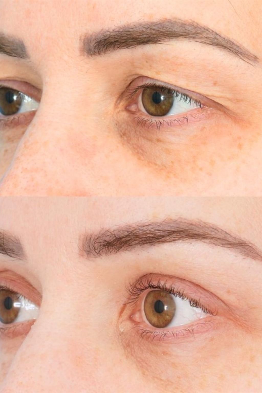 Left side vertical image - Eyelid Augmentation results