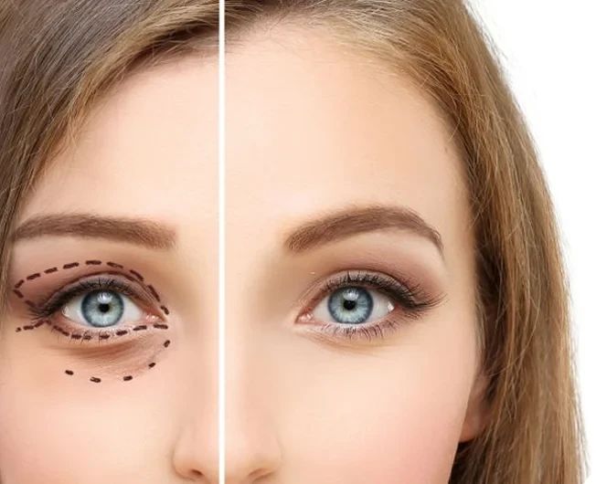 Lower Eye Lid Augmentation