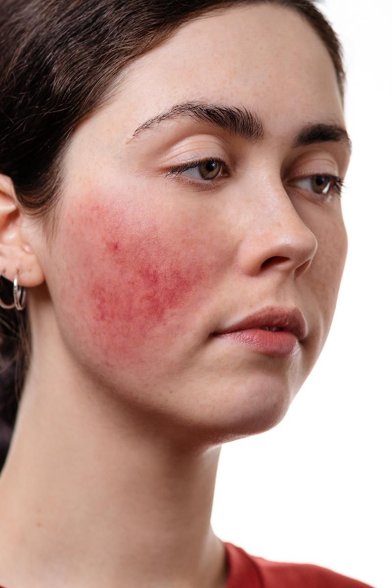 Rosacea Treatment Gorakhpur