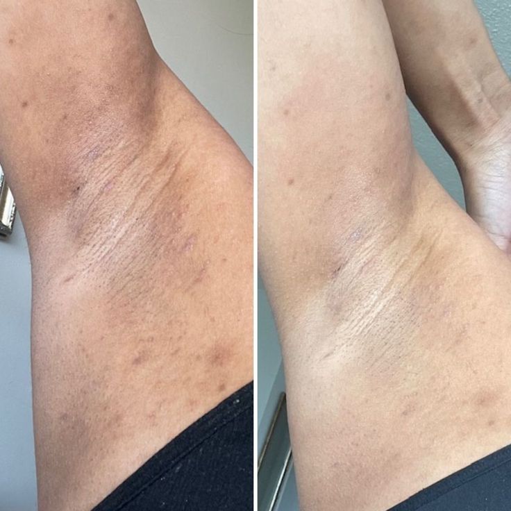 Who Can Benefit from Body Lightening Booster Therapy