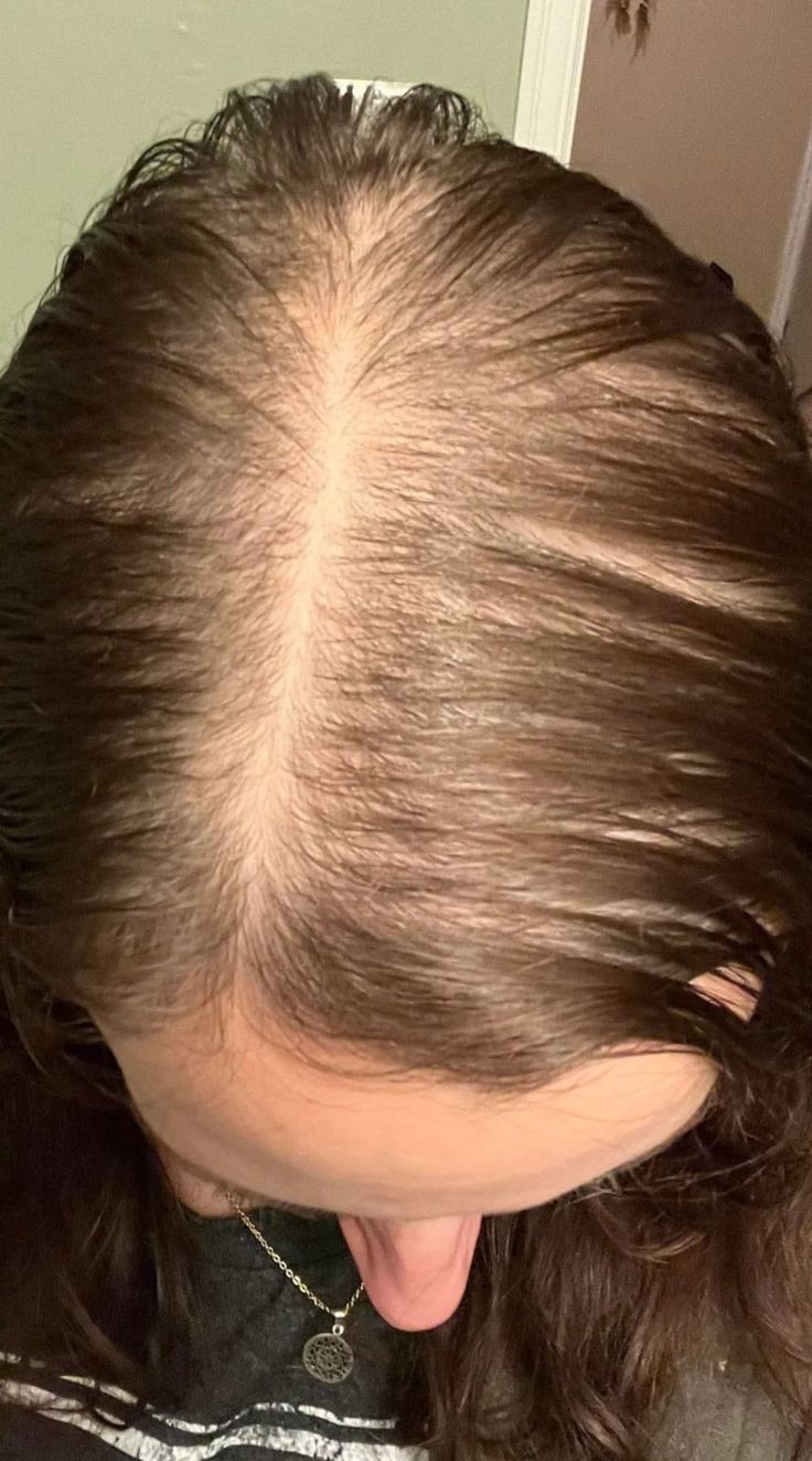 Hair Thinning Treatment Gorakhpur