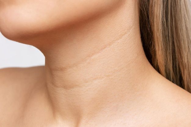 Neck Rejuvenation – Tightening, Wrinkle Repair & Youthful Contour
