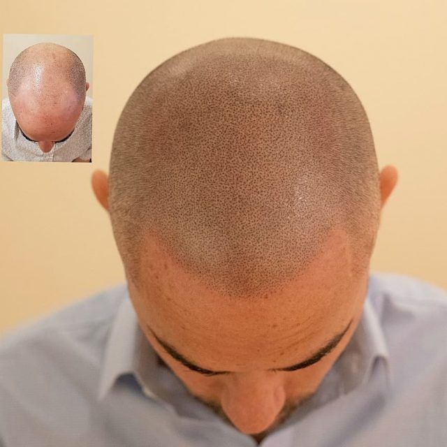 Ideal Candidates for Scalp Micro-Pigmentation at KM Orgatonics – Hair Coverage & Confidence Restoration in Gorakhpur