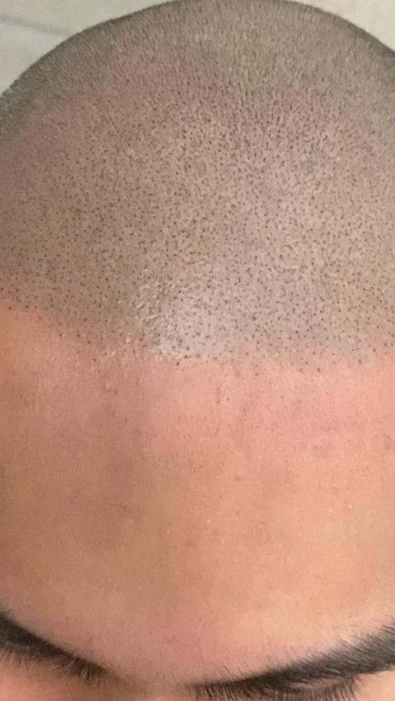 Scalp Micropigmentation Gorakhpur