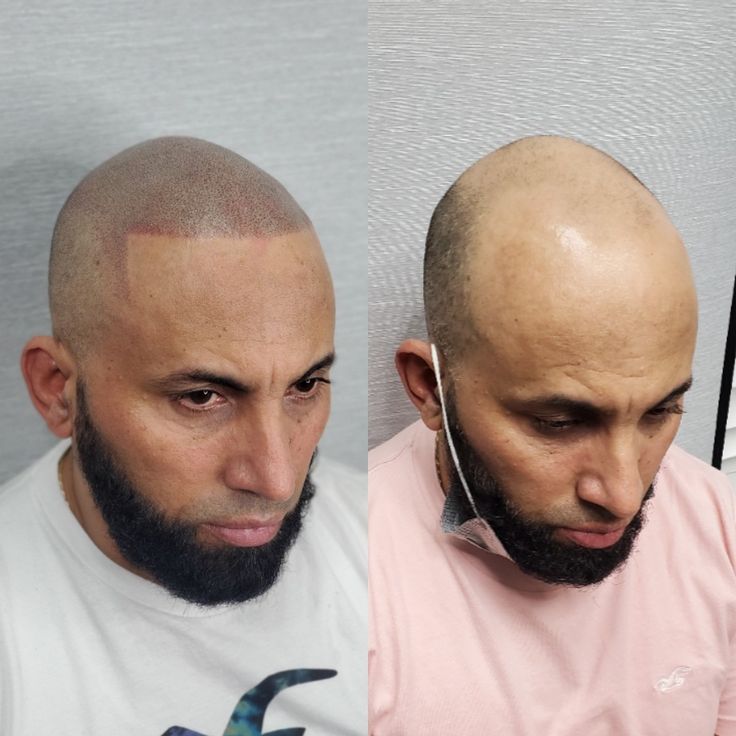 Hairline Simulation Gorakhpur