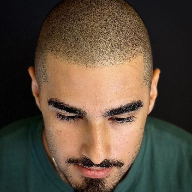 Scalp Micro-Pigmentation – Hairline Simulation & Bald Spot Coverage at KM Orgatonics