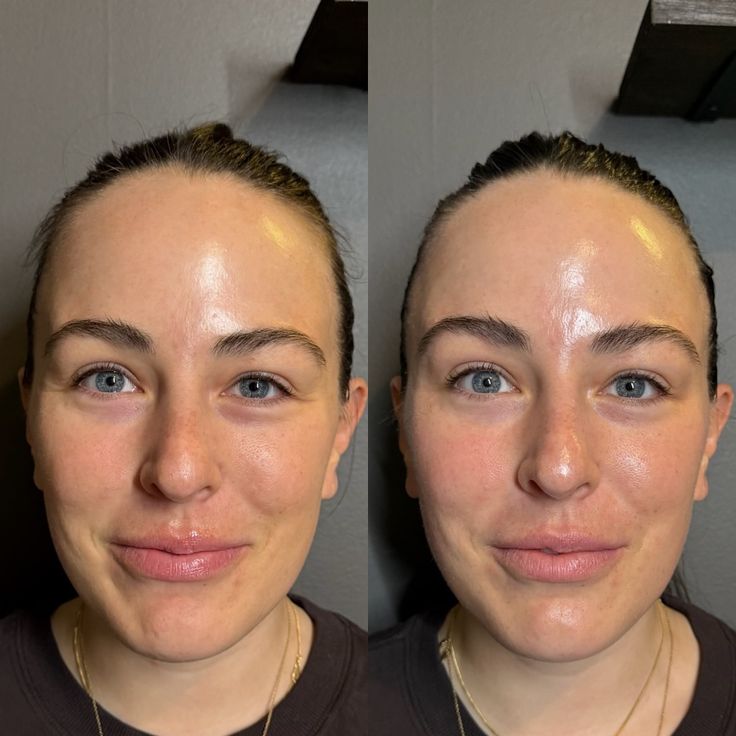 Non-Invasive Facelift KM Orgatonics – Defined Jawline & Facial Contour