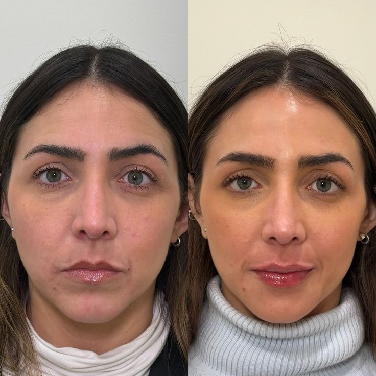 Skin Tightening Facial Treatment Gorakhpur – Lifted & Radiant Skin