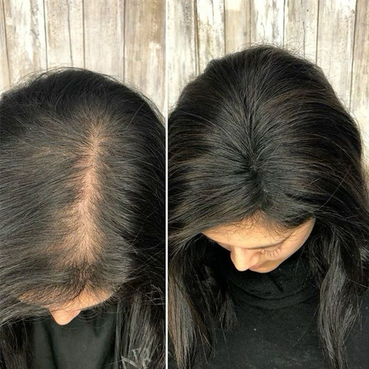 Scalp Detox Hair Transformation - Before & After 2