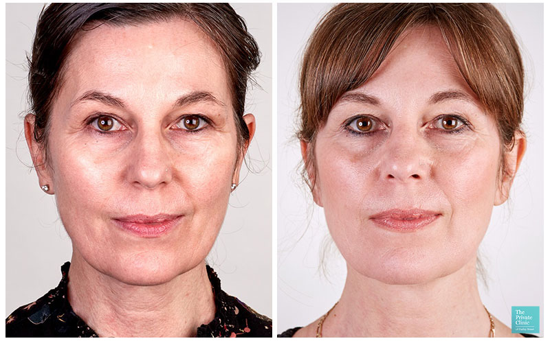 non invasive facelift Gorakhpur