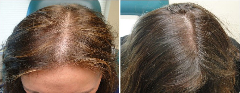 hair loss treatment Gorakhpur