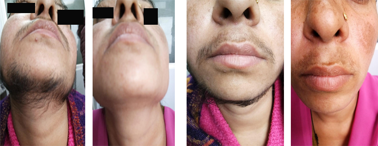 Laser Hair Removal Gorakhpur