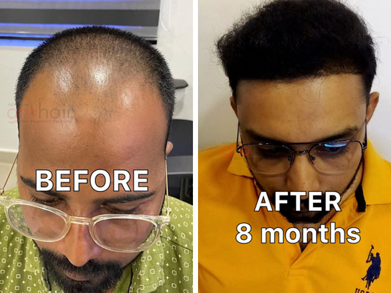 Hair Loss Treatment Gorakhpur