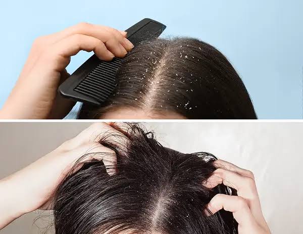 Dandruff Treatment