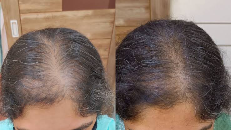 GFC Treatment