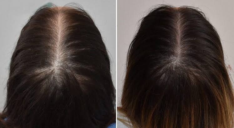 Hair Loss