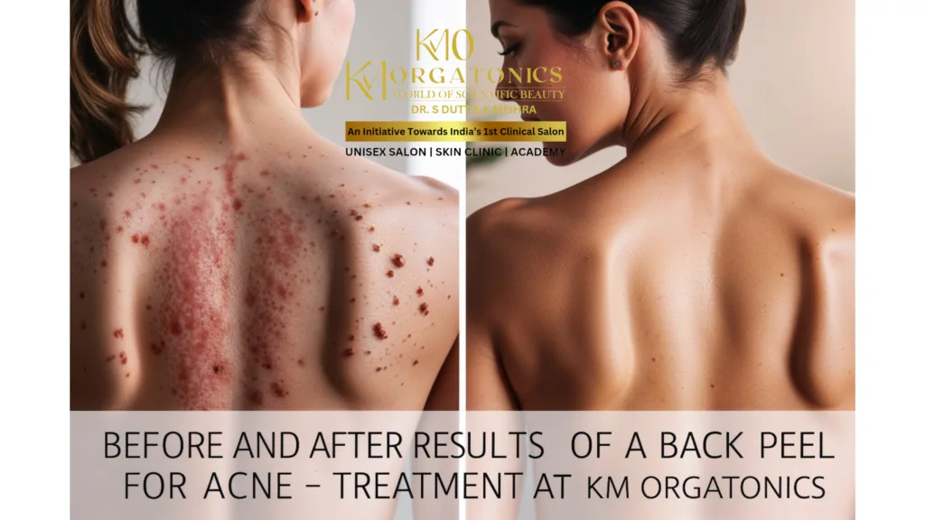 Before & after photos showcasing the effectiveness of KM Orgatonics' back peel treatment for acne. See the dramatic improvement in skin clarity and texture.