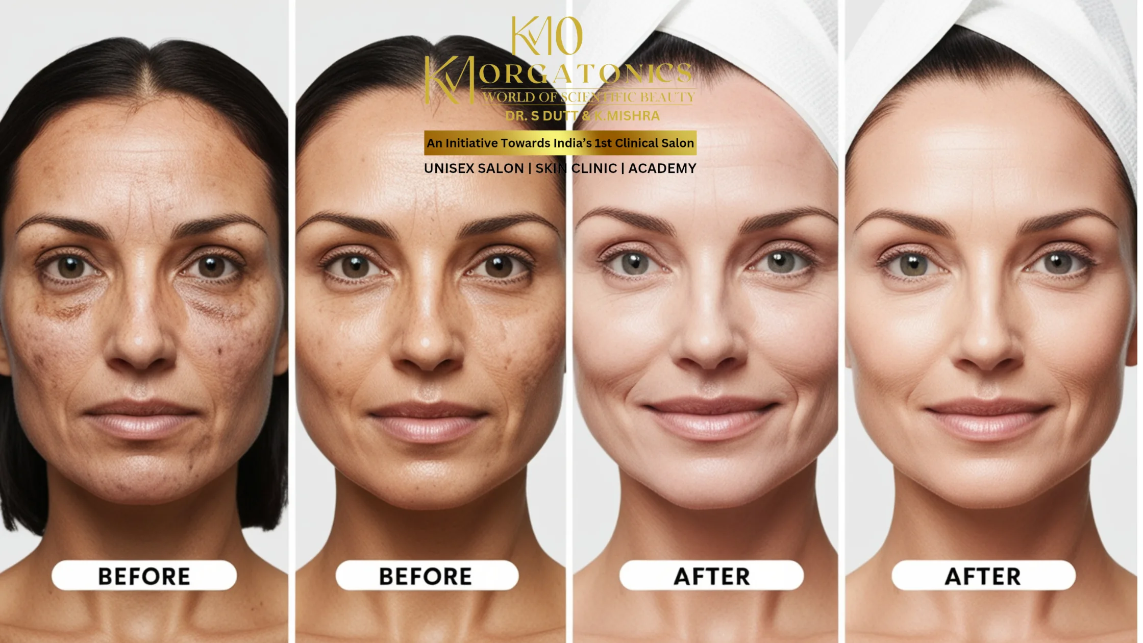 Before-and-after images of a woman's face demonstrating the visible improvements in skin tone and texture after receiving a carbon peel treatment at KM Orgatonics.